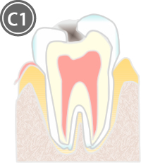 C1：エナメル質内の虫歯