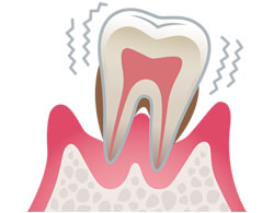 歯周病とは